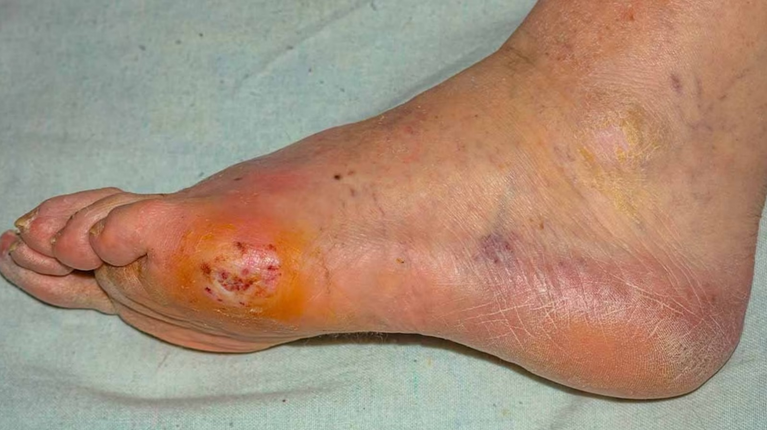 Diabetes – Foot sores and Infection