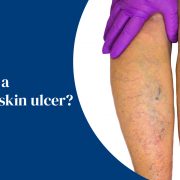 What is a venous skin ulcer?