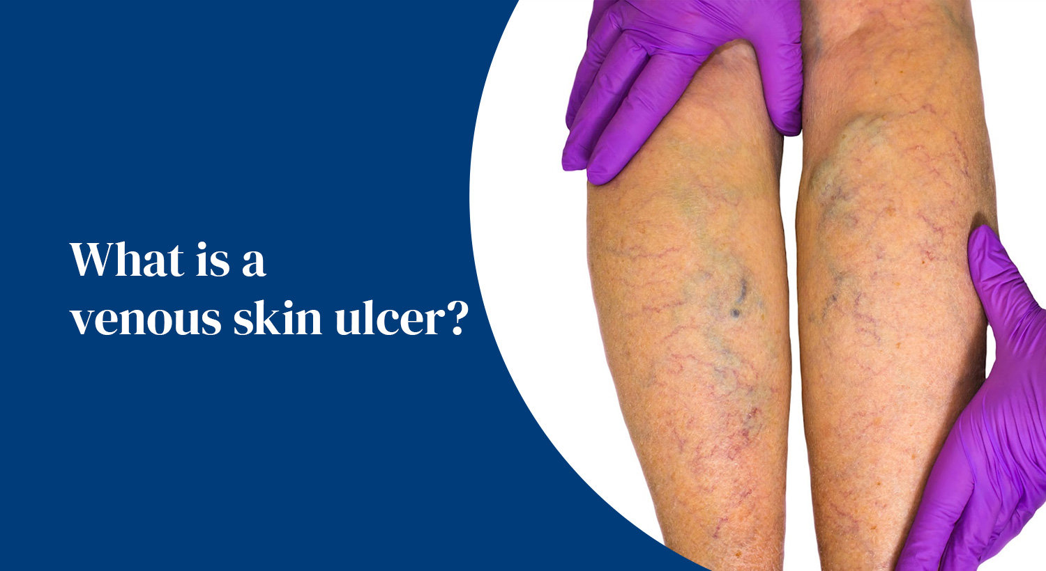What is a venous skin ulcer