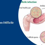 Clostridium Difficile Infection (C. Diff.)