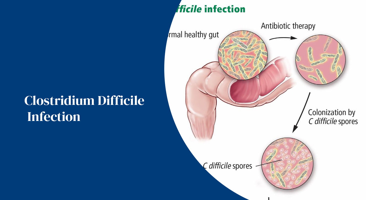 Clostridium Difficile Infection