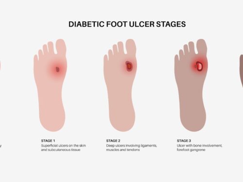 Diabetic Foot Ulcer Doctor’s Clinic