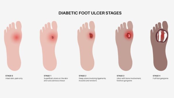 Diabetic Foot Ulcer Doctor’s Clinic GA – Prevention & Care